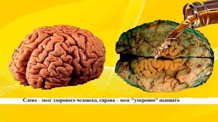 Мозг пьющего человека